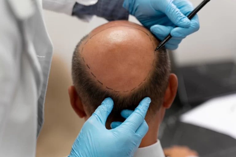Hair Transplant Clinic in Andheri West